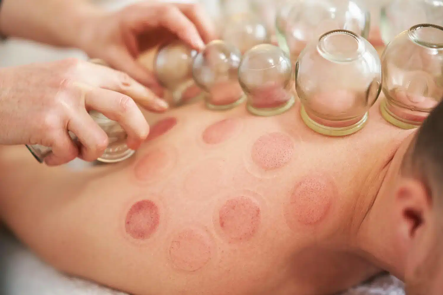 cupping therapy marks on back showing post workout recover