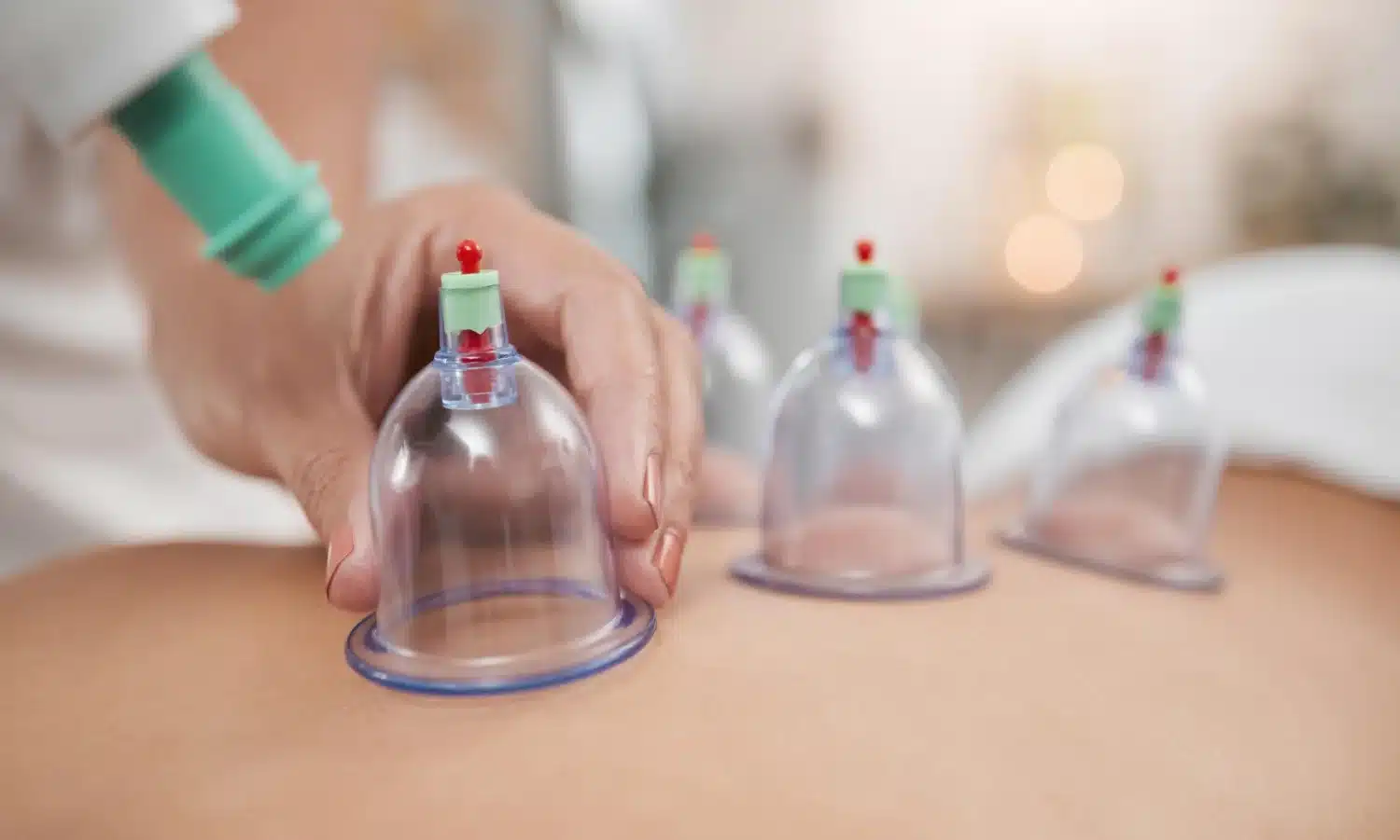cupping therapy treatment for muscle tension and recovery