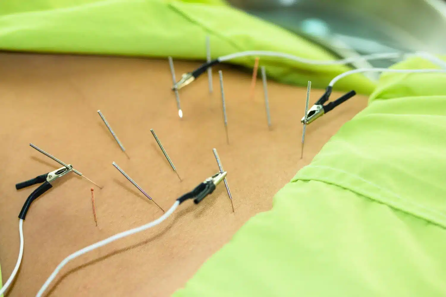 Acupuncture and Dry Needling is same?