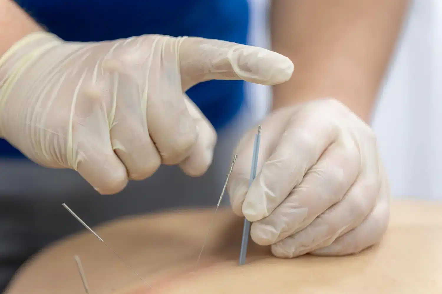 What is Dry Needling?