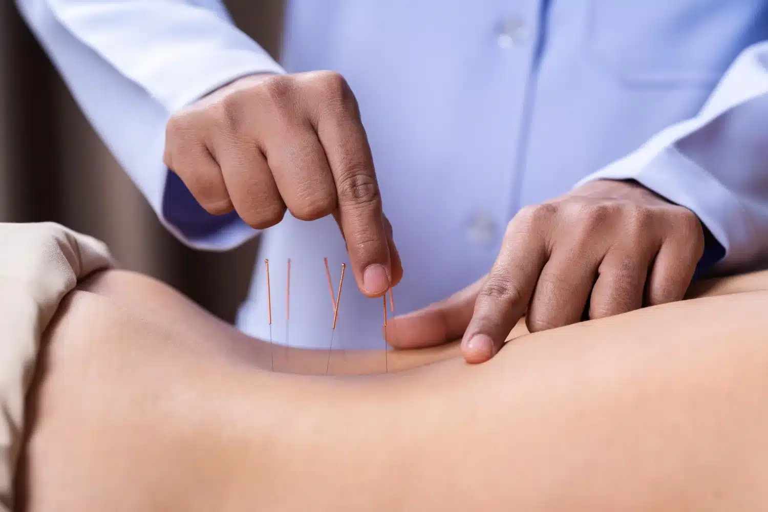 Acupuncture vs Dry Needling